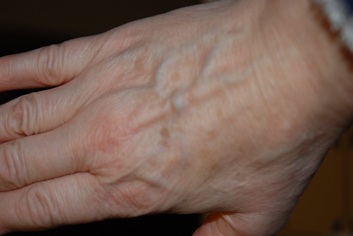 Simptomele cancerului apar prima dată pe mână. Cum arată