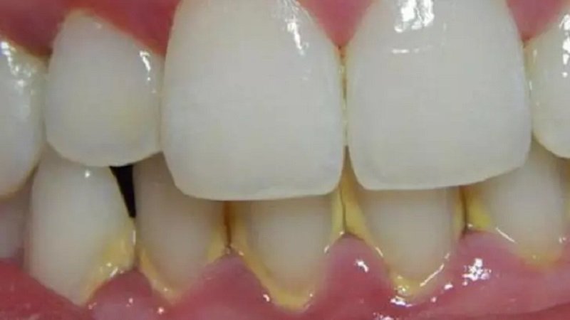 Cum scapi RAPID de tartrul de pe dinți fără să mergi la dentist