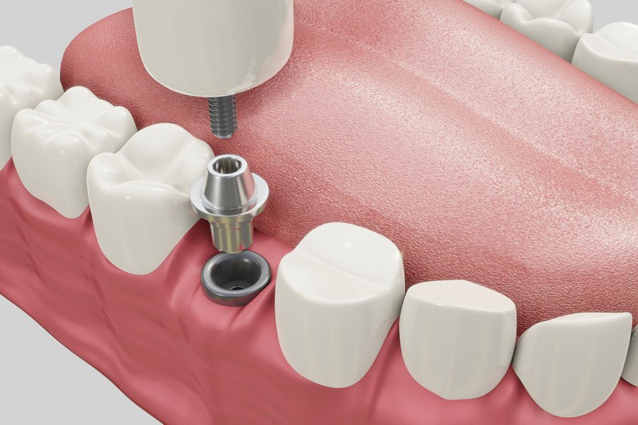 Instalarea implantului dentar: cum, cui și de ce?