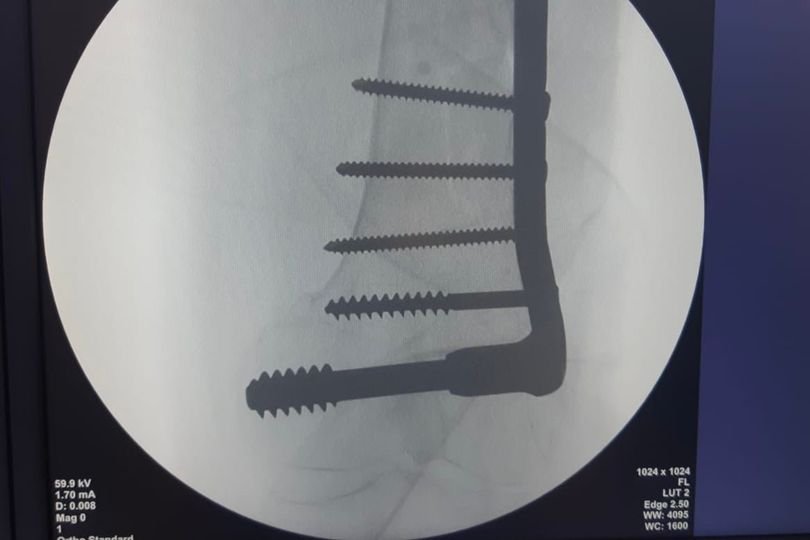 Pacientă din Kiev operată de urgenţă de medicii de la Judeţean pentru a i se salva un picior