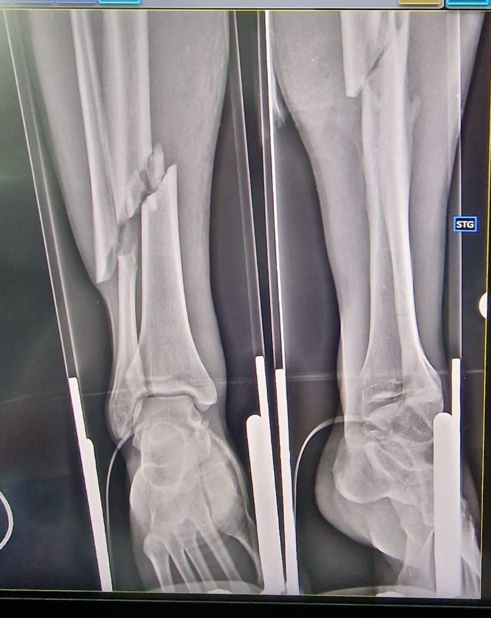 Picioarele unui tânăr implicat într-un accident rutier salvate de medicii de la Judeţean; cât a durat intervenţia