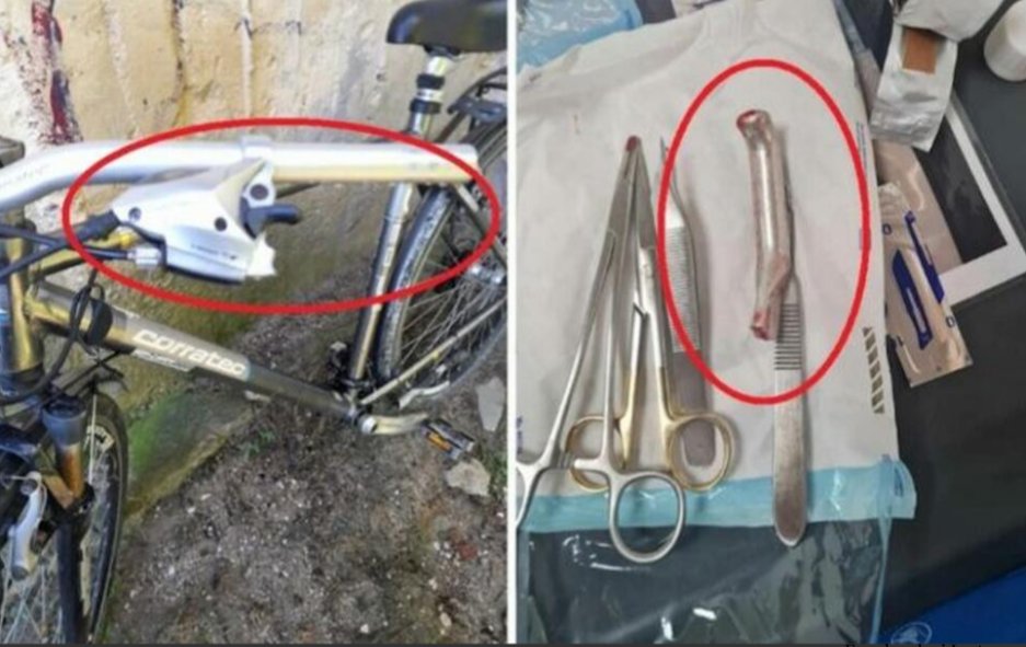 Vai de capul lui: un medic este acuzat că a cusut în piciorul unui pacient... mânerul frânei de la bicicletă