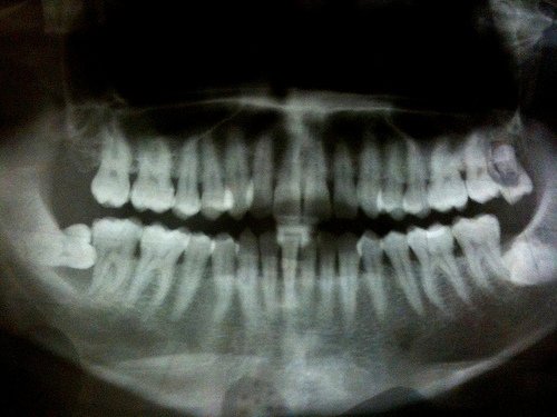 Infecţia pe care o au 8 din 10 români, dar nu ştiu de ea