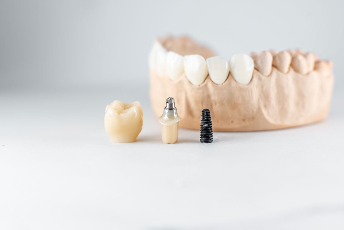 Totul despre implantul dentar Neodent: O opțiune tot mai populară